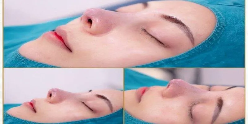 Các dấu hiệu sau khi phẫu thuật mũi
