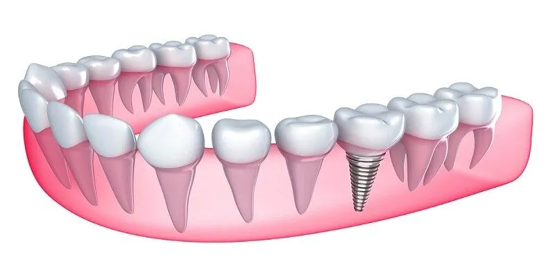 Cấy Implant là như thế nào – Giải pháp phục hồi răng mất tối ưu