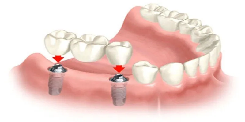 Cấy implant là như thế nào? Implant đơn lẻ