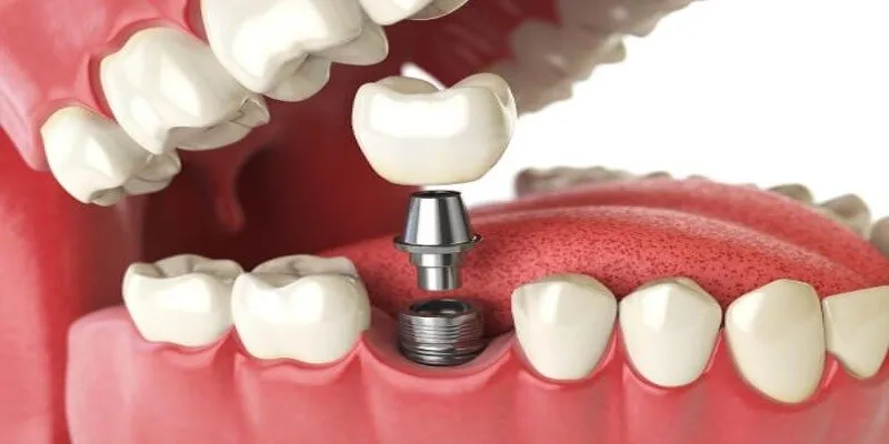 Cấy Implant là như thế nào? Những lợi ích không thể bỏ qua