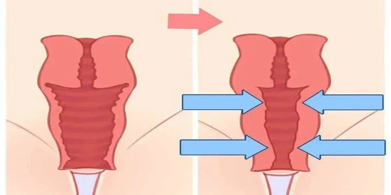 Công nghệ laser cho việc trẻ hóa âm đạo