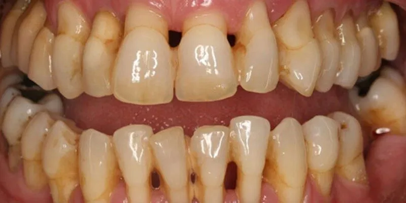 Hiểu rõ về bệnh nha chu và tác hại