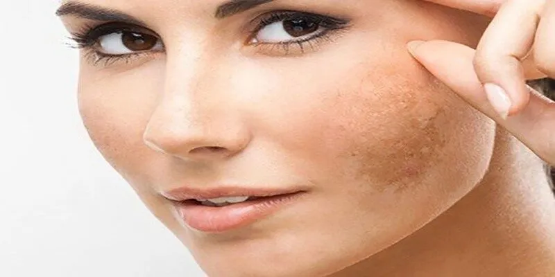 Phương pháp Mesotherapy là cách điều trị nám hiệu quả