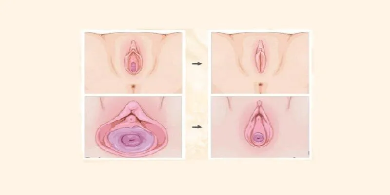 Phương pháp trẻ hóa bằng phẫu thuật vùng kín