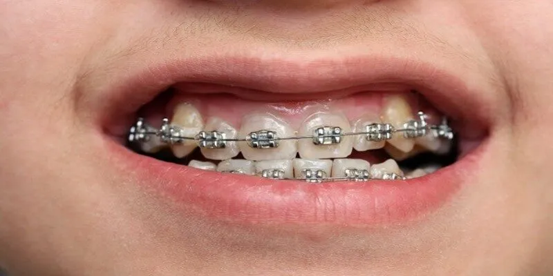 Siết răng định kỳ làm đau vài ngày