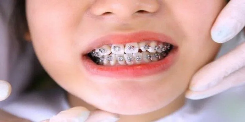 Tách kẽ – Khoảng trống đầu tiên được tạo ra
