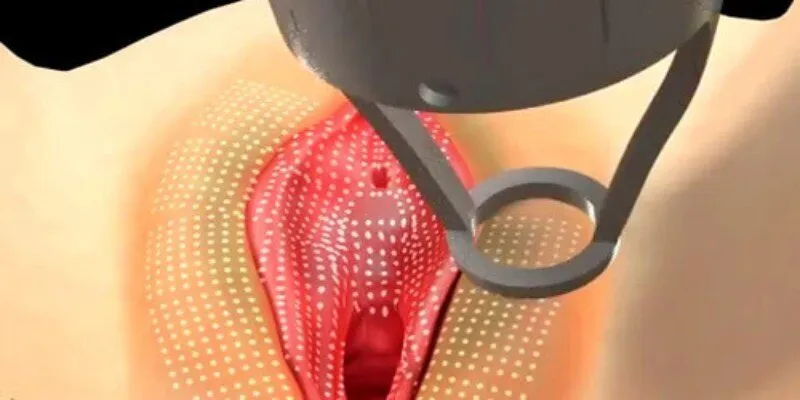 Tầm quan trọng của trẻ hóa âm đạo